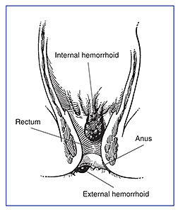 Foto Penyakit Wasir / Ambeien / Hemorroid