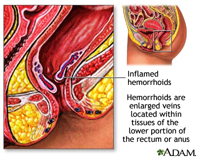 Foto Kenapa Anus Keluar Benjolan dan Saat BAB Sakit